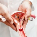 Reproductive Health Doctor for PCOS in Delhi