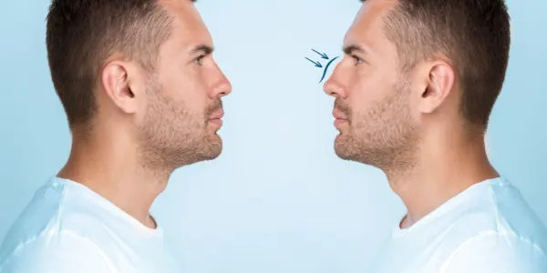 nasal bone fracture treatment​