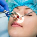 nasal polyps surgery​